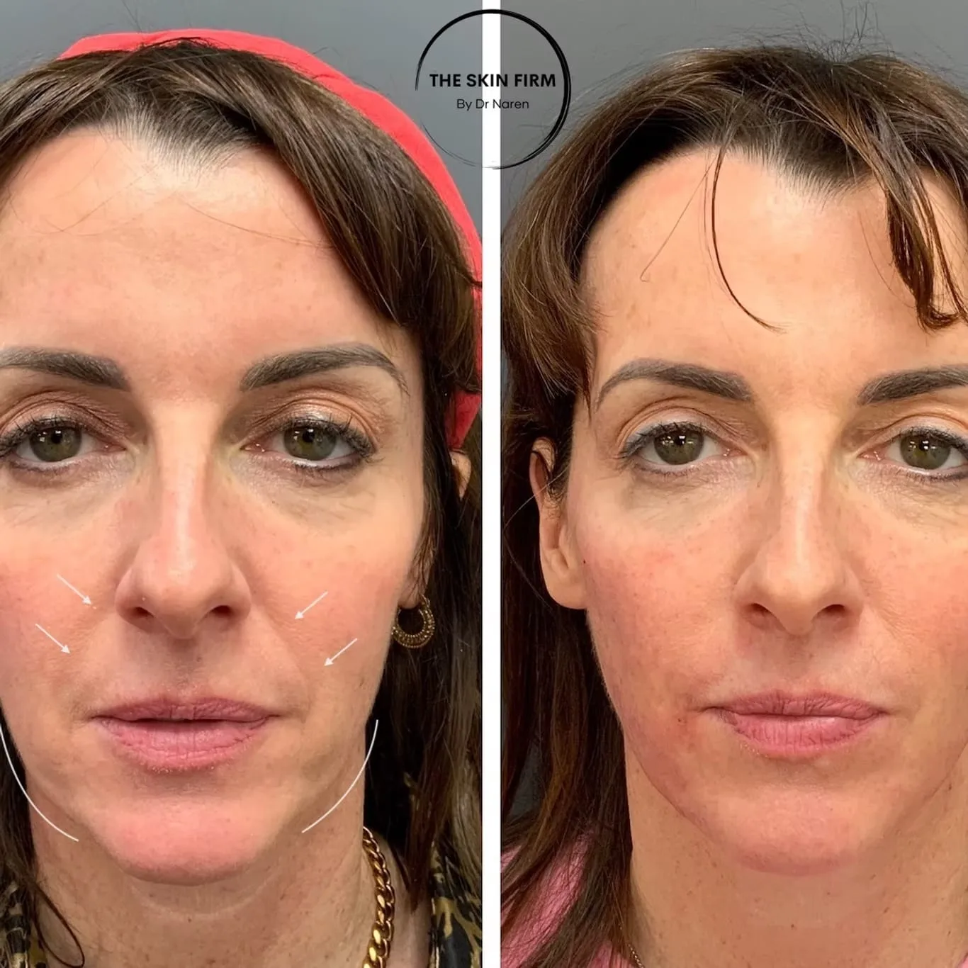 Non-Surgical Face Lift before and after at The Skin Firm