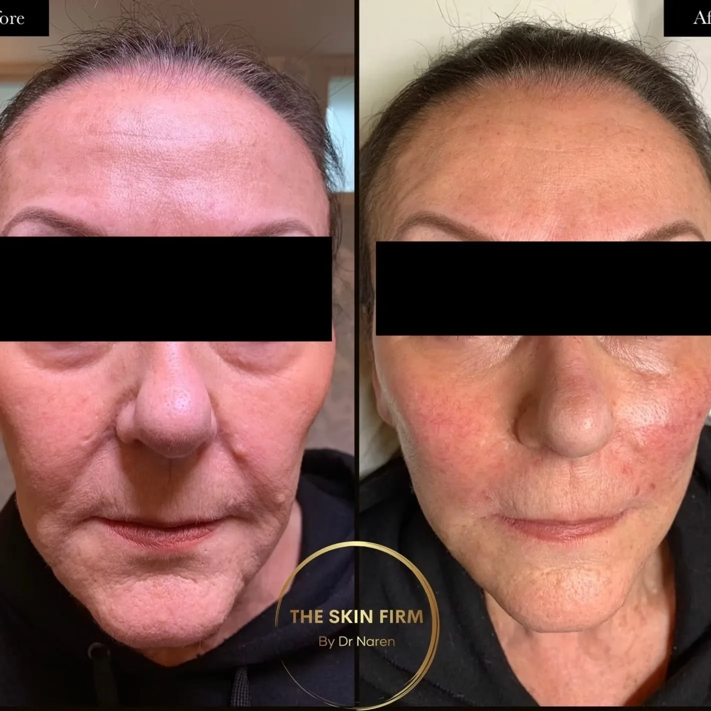 Non-Surgical Face Lift before and after at The Skin Firm