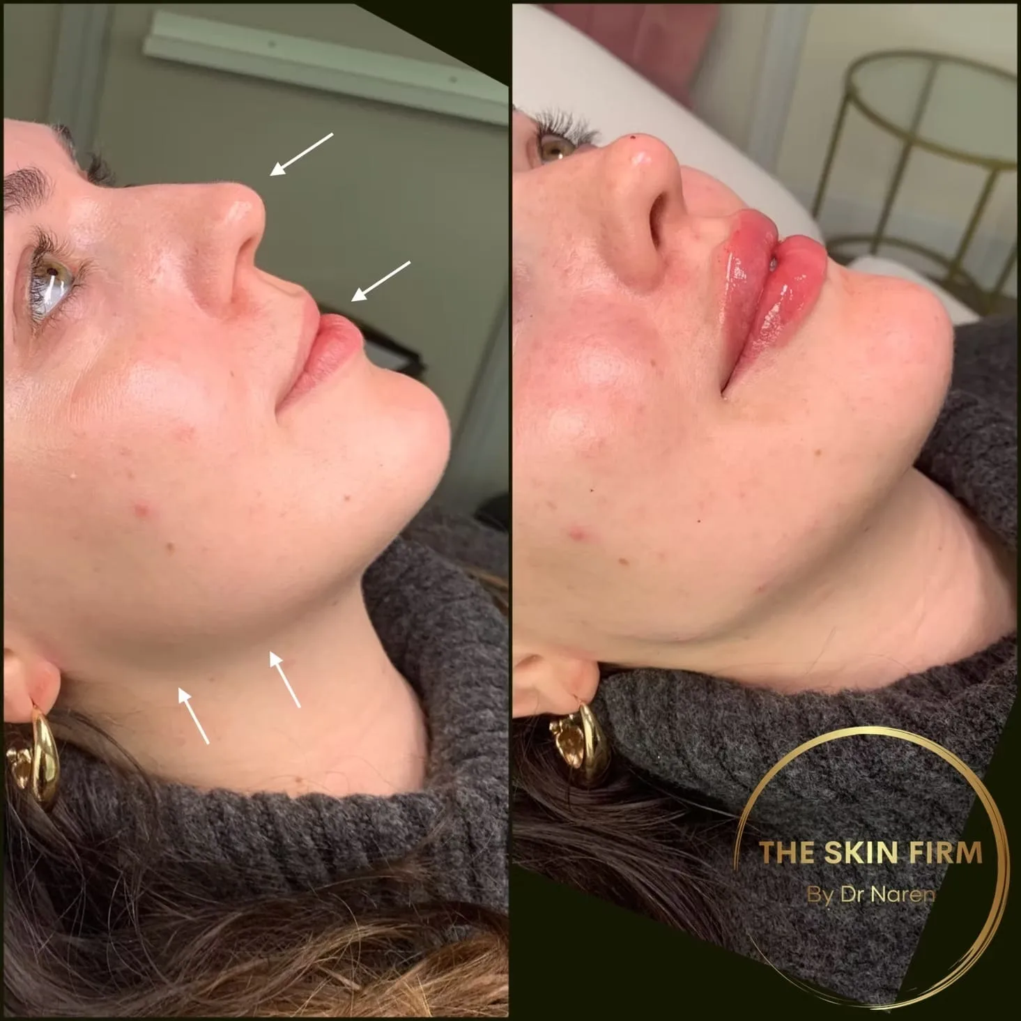 Jawline, Lips & Nose Filler before and after at The Skin Firm