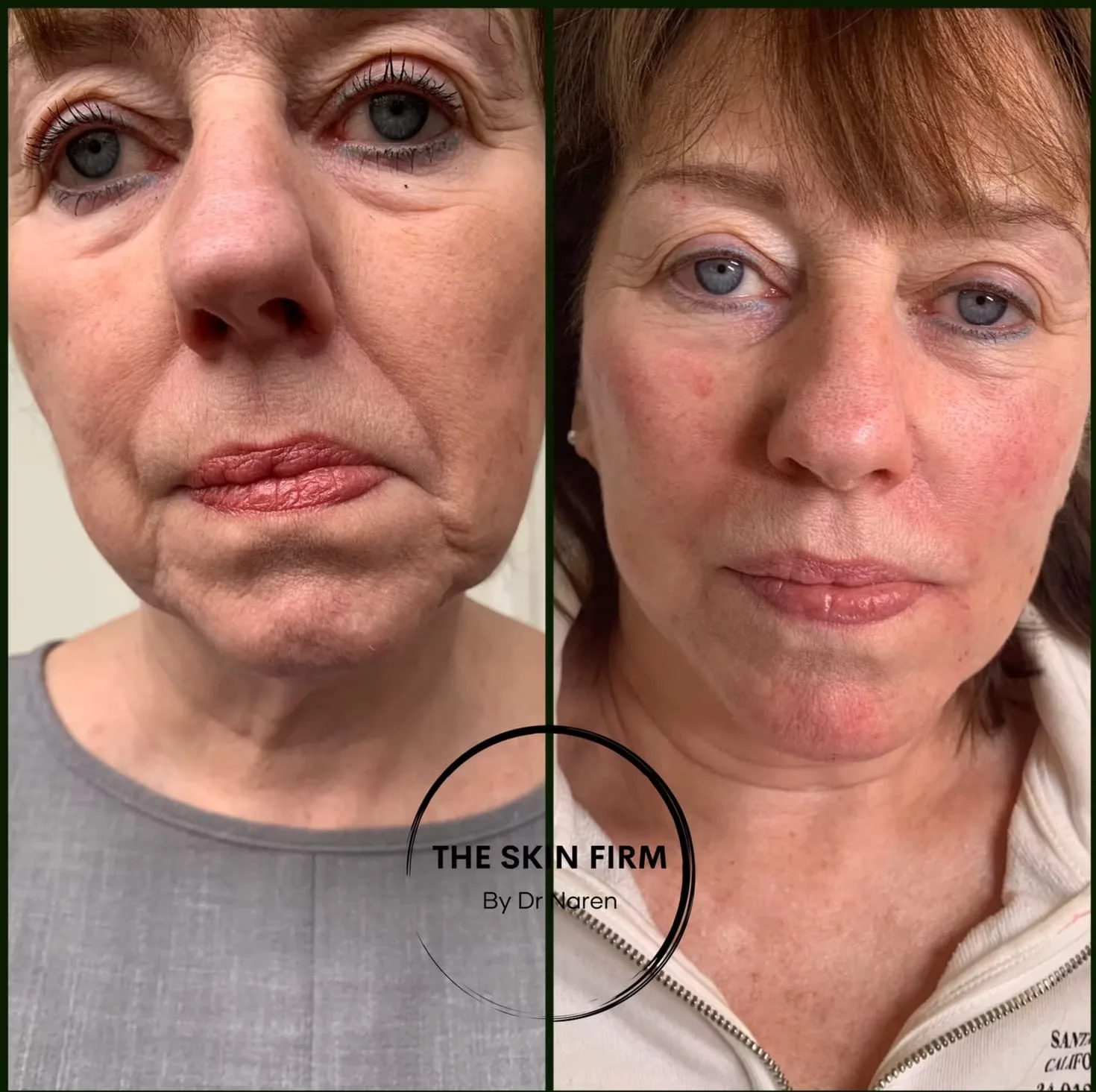 Non-Surgical Face Lift before and after at The Skin Firm