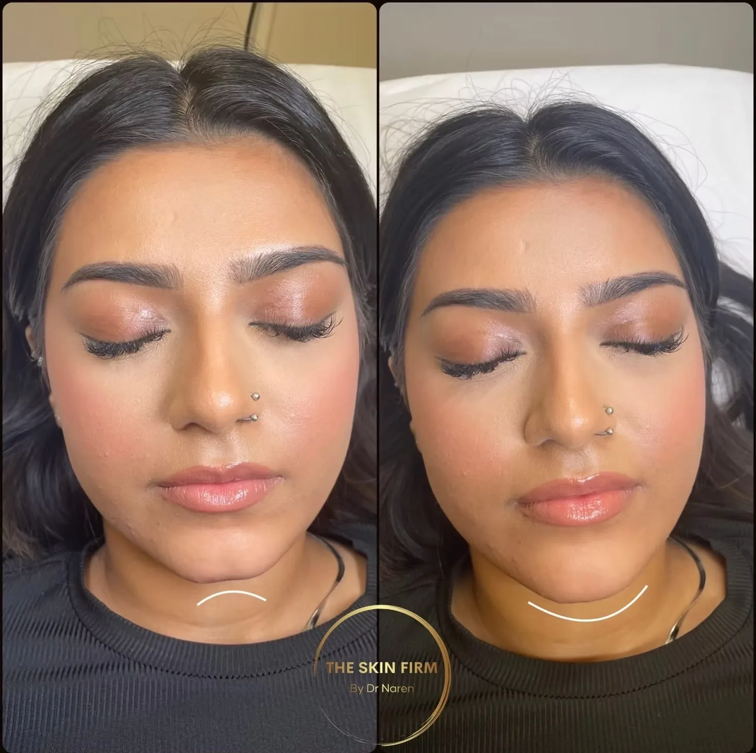 Non-Surgical Face Lift before and after at The Skin Firm