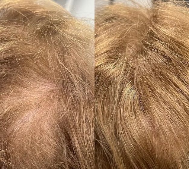 Hair Loss Treatment before and after at The Skin Firm
