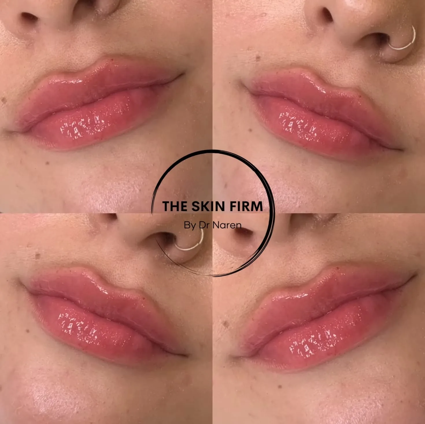 Lip Fillers before and after at The Skin Firm