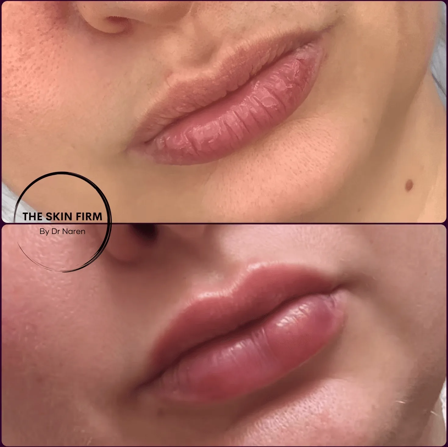 Lip Fillers before and after at The Skin Firm