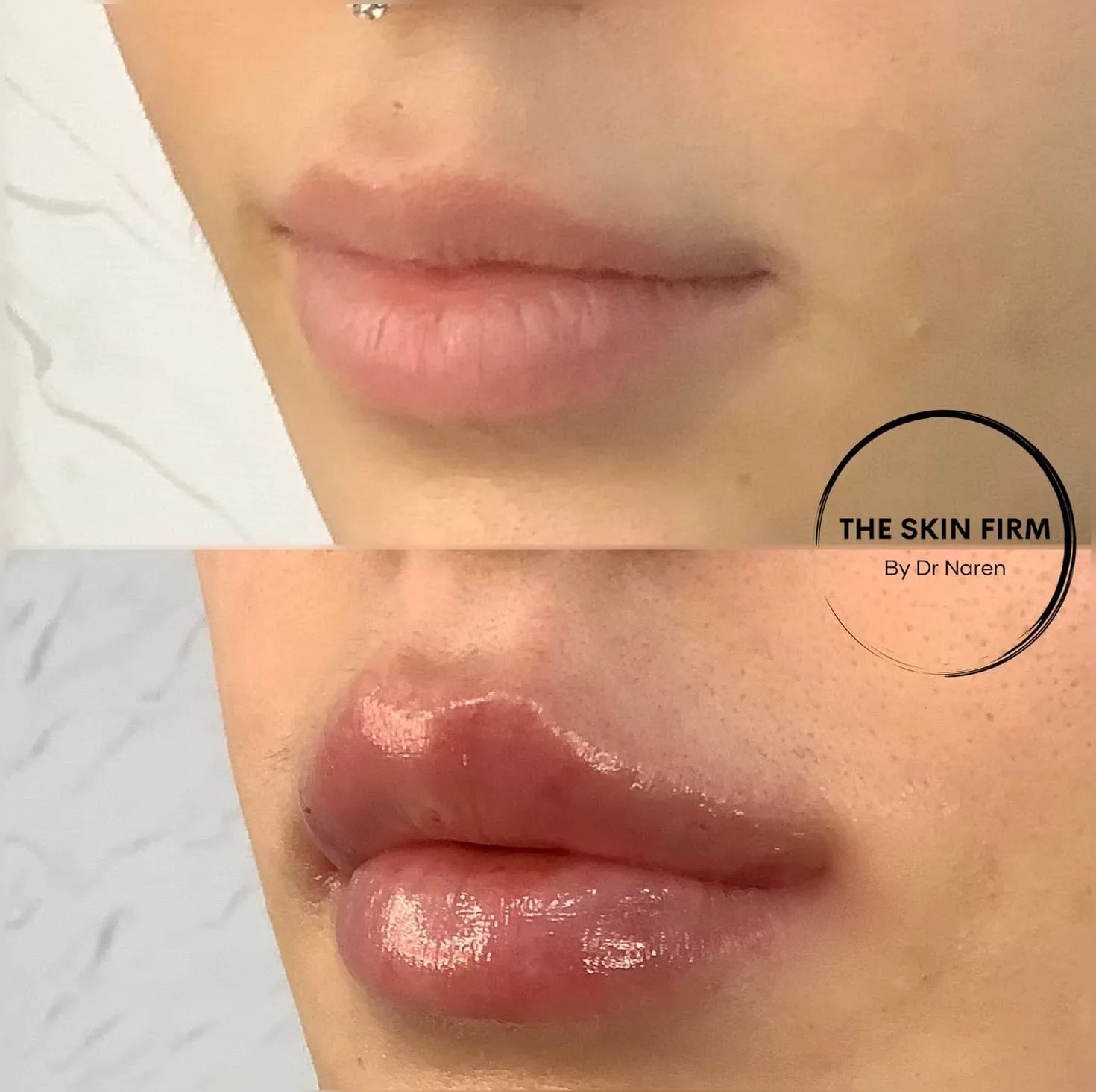 Lip Fillers before and after at The Skin Firm