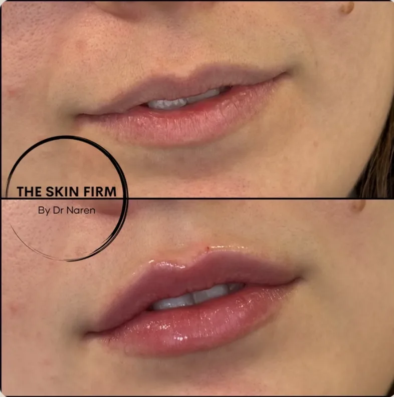 Lip Fillers before and after at The Skin Firm