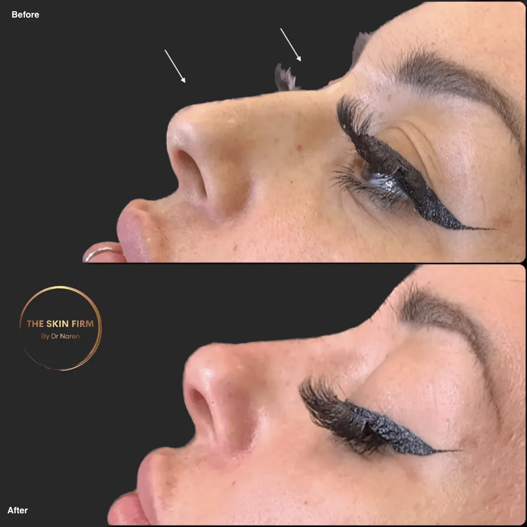 Non-Surgical Rhinoplasty before and after at The Skin Firm